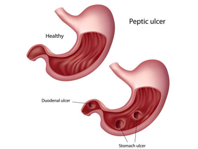 Infectia cu Helicobacter Pylori, una dintre cauzele ulcerului